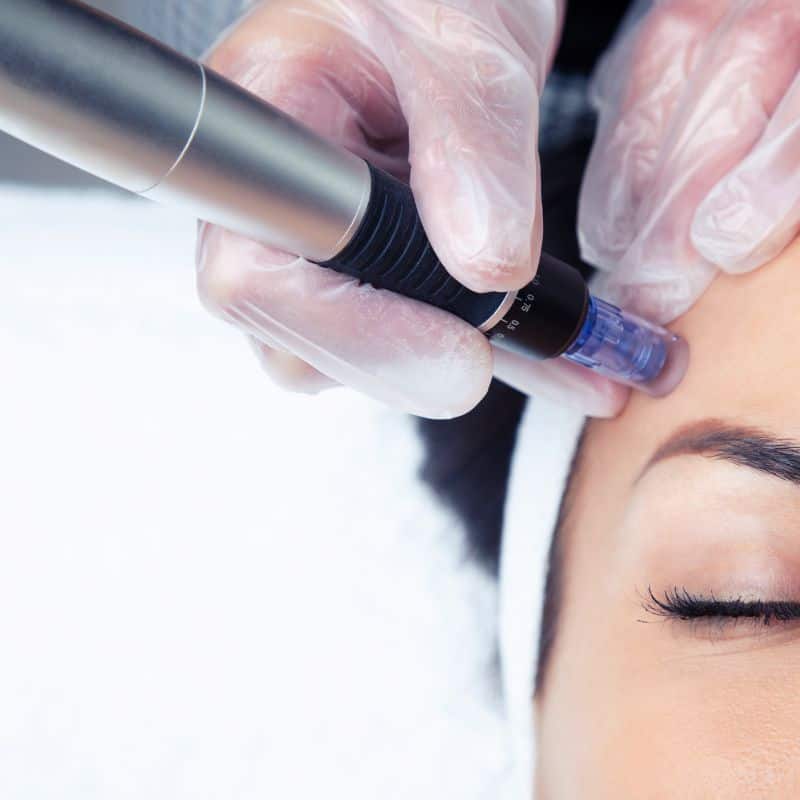 Morpheus8 treatment Kingston upon Thames from Lipo Sculpt - Book in today!